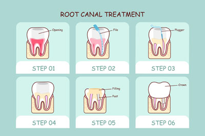 Root Canal Therapy