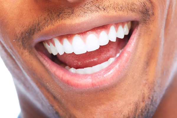 A Smile Makeover Plan To Beautify Teeth Shape