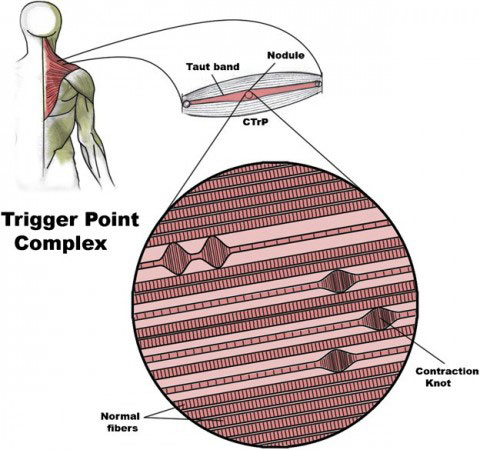 Trigger points