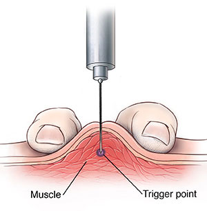 Trigger points