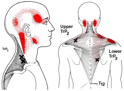 Trigger points