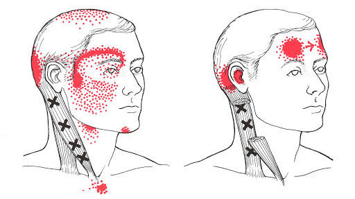 Trigger points